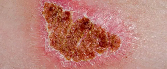 A scab on a healing wound